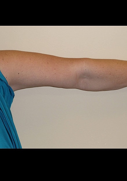 Arm Lift Before & After