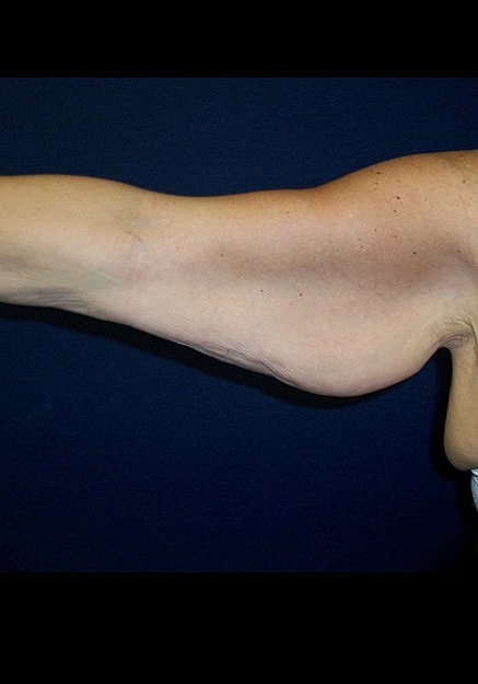 Arm Lift Before & After