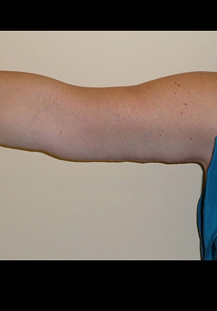Arm Lift Before & After