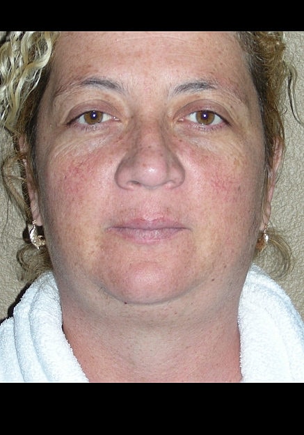 Vaser Liposuction Of Neck And Double Chin Before & After
