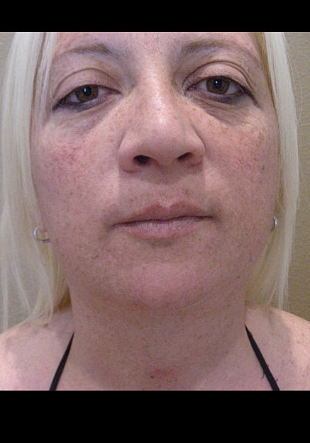 Vaser Liposuction Of Neck And Double Chin Before & After