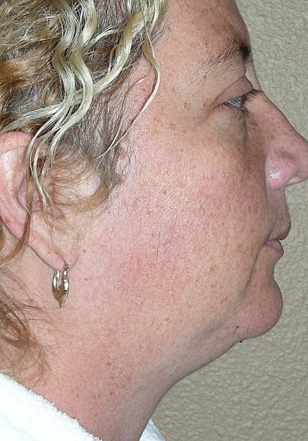 Vaser Liposuction Of Neck And Double Chin Before & After