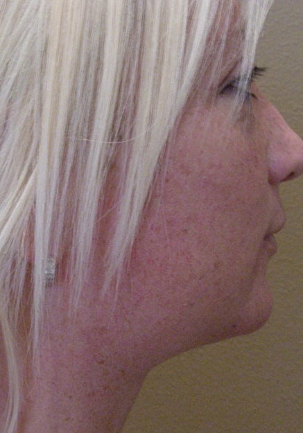 Vaser Liposuction Of Neck And Double Chin Before & After