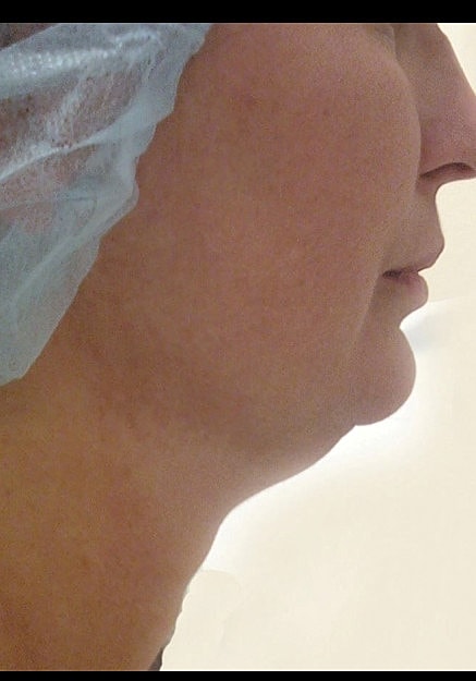 Vaser Liposuction Of Neck And Double Chin Before & After