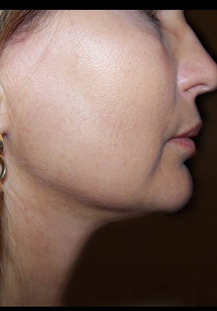 Vaser Liposuction Of Neck And Double Chin Before & After