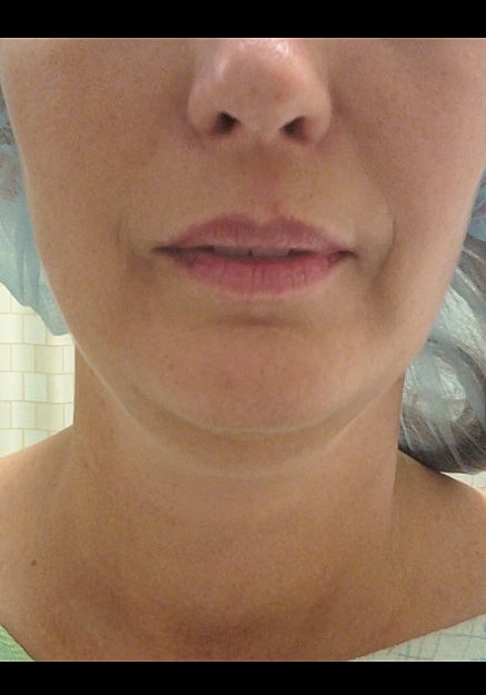 Vaser Liposuction Of Neck And Double Chin Before & After