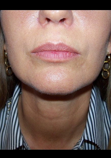 Vaser Liposuction Of Neck And Double Chin Before & After