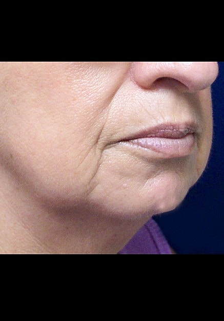 Chin Implants Before & After