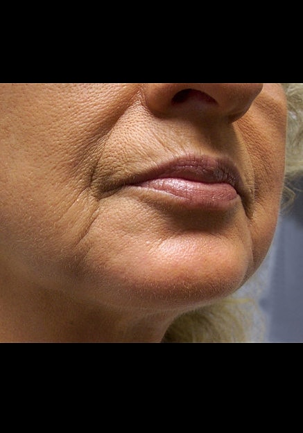Chin Implants Before & After