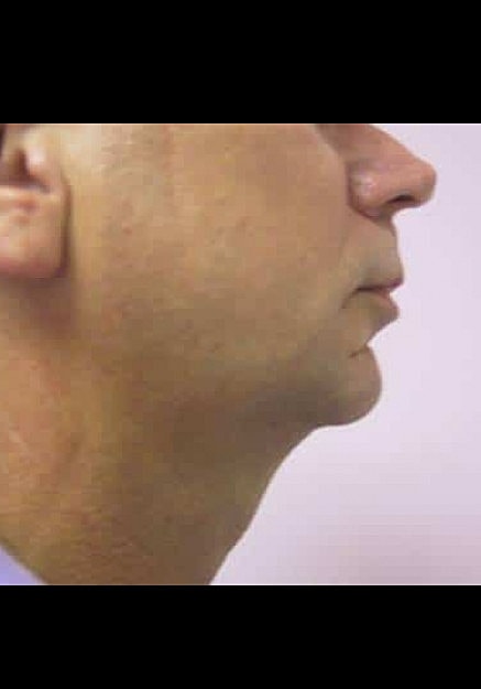 Chin Implants Before & After