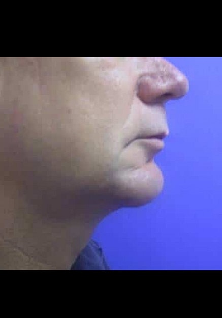 Chin Implants Before & After
