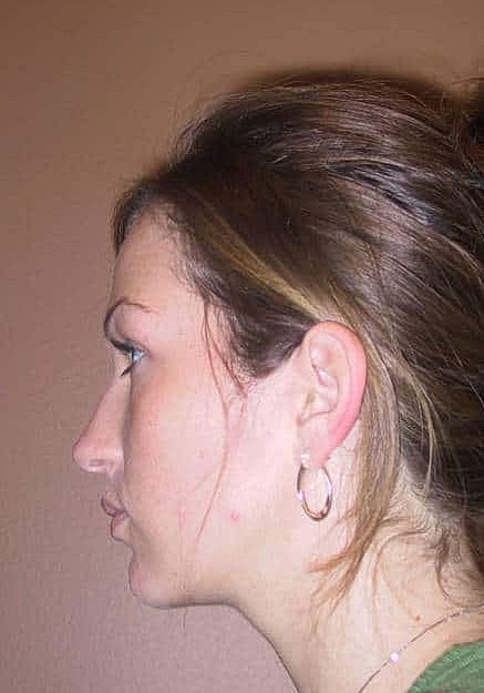 Chin Implants Before & After