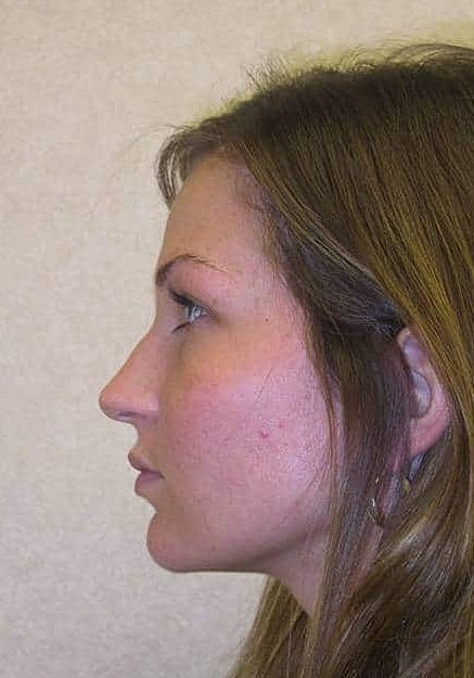 Chin Implants Before & After