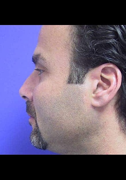 Chin Implants Before & After