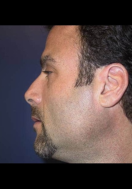 Chin Implants Before & After