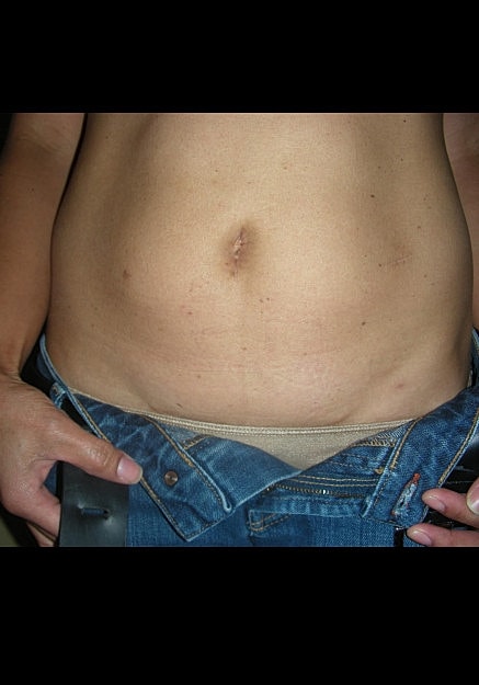Tummy Tuck Before & After