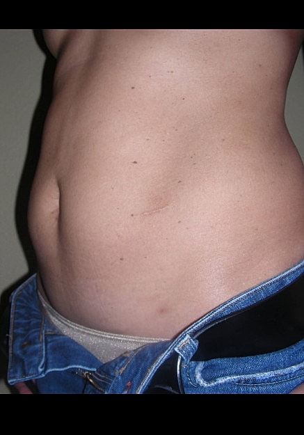 Tummy Tuck Before & After