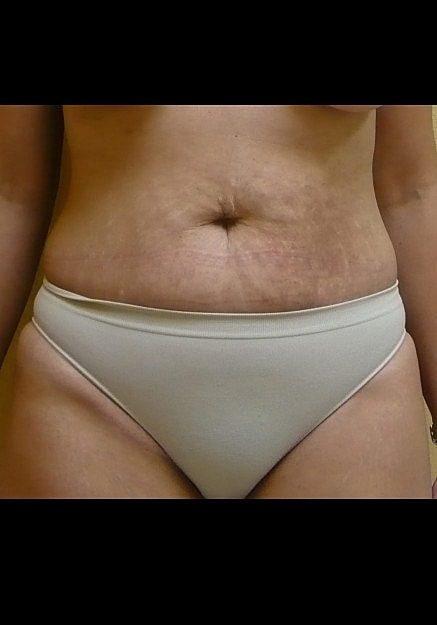 Tummy Tuck Before & After