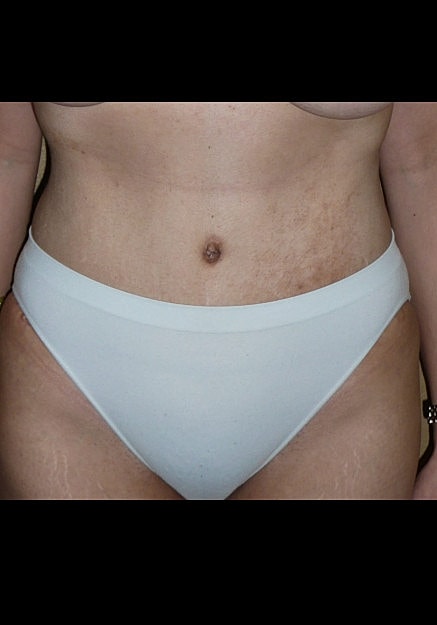 Tummy Tuck Before & After
