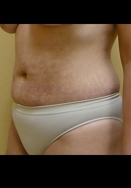 Tummy Tuck Before & After