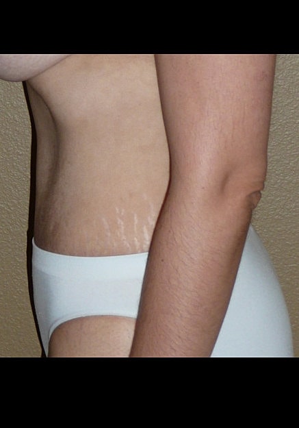 Tummy Tuck Before & After
