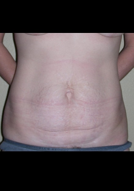Tummy Tuck Before & After