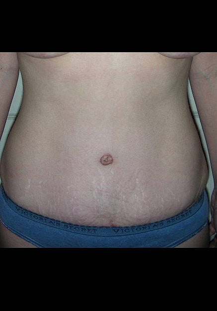 Tummy Tuck Before & After