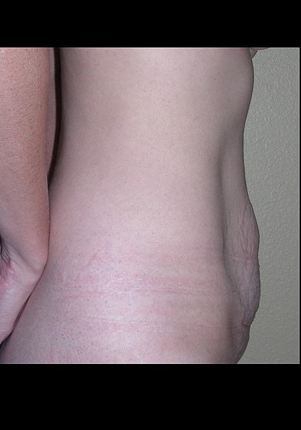 Tummy Tuck Before & After