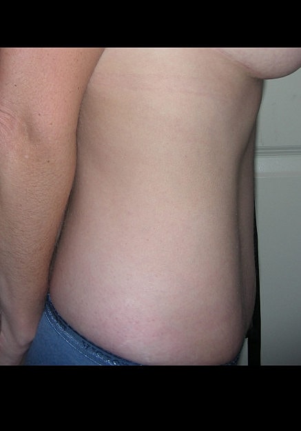 Tummy Tuck Before & After