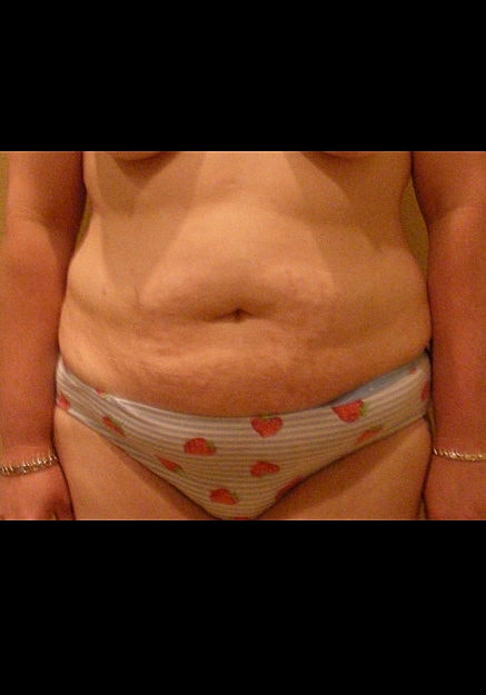 Tummy Tuck Before & After