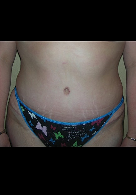 Tummy Tuck Before & After
