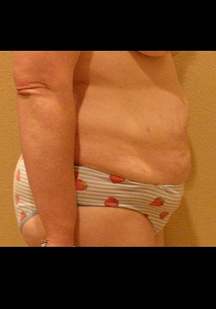 Tummy Tuck Before & After
