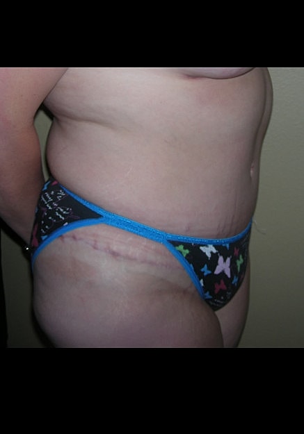 Tummy Tuck Before & After