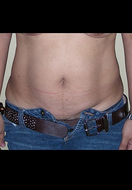 Tummy Tuck Before & After