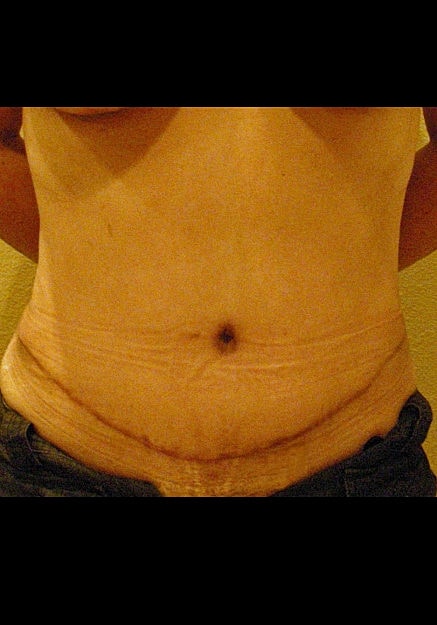 Tummy Tuck Before & After