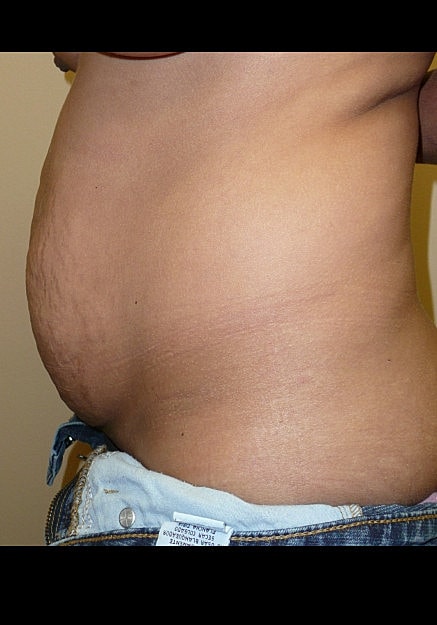Tummy Tuck Before & After