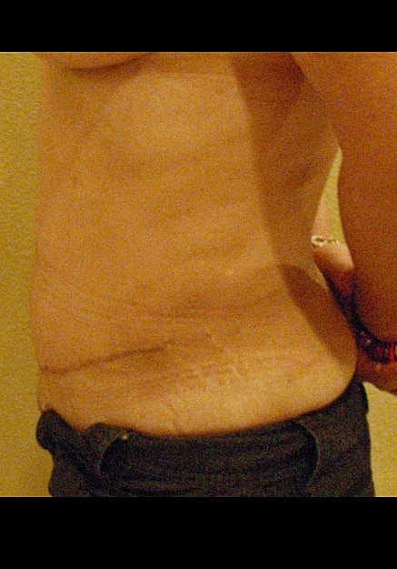 Tummy Tuck Before & After