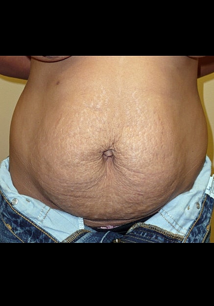 Tummy Tuck Before & After