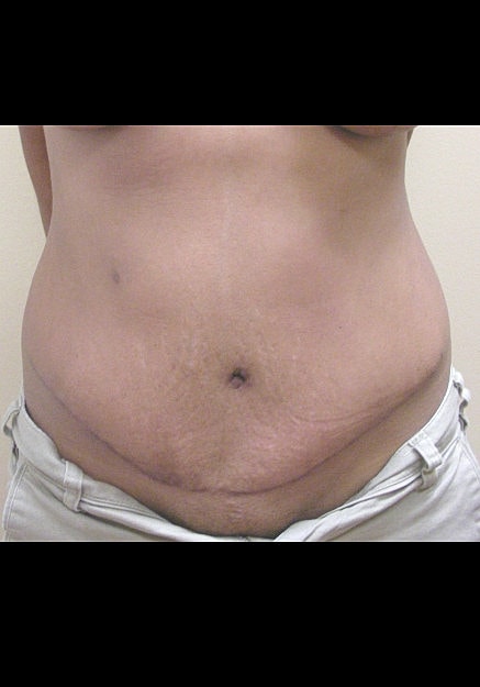 Tummy Tuck Before & After