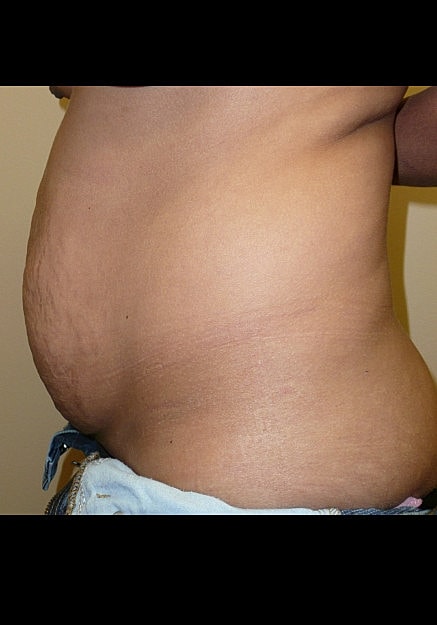 Tummy Tuck Before & After
