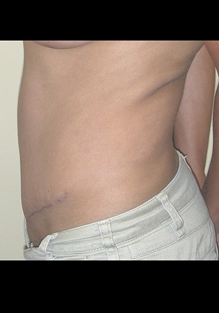 Tummy Tuck Before & After