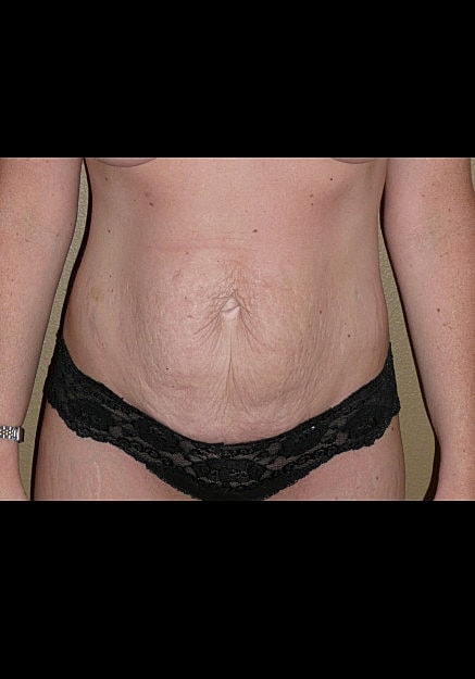 Tummy Tuck Before & After
