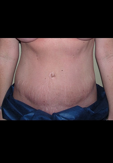 Tummy Tuck Before & After