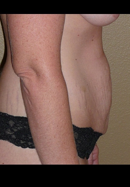 Tummy Tuck Before & After