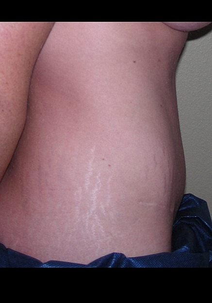 Tummy Tuck Before & After