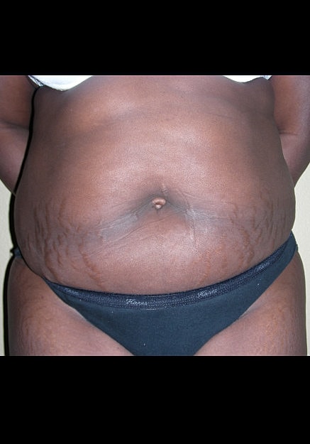 Tummy Tuck Before & After