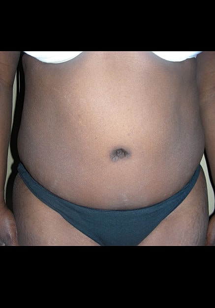 Tummy Tuck Before & After