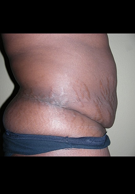 Tummy Tuck Before & After