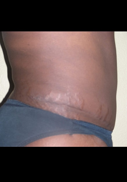Tummy Tuck Before & After