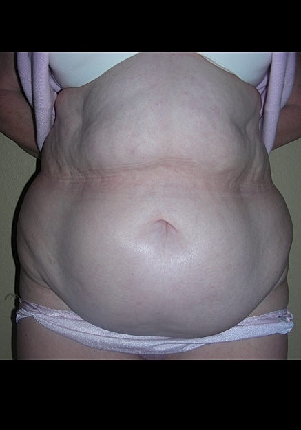 Tummy Tuck Before & After